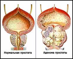 Что влияет на размер предстательной железы